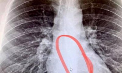 Man swallows AirPod while sleeping, does not realize it