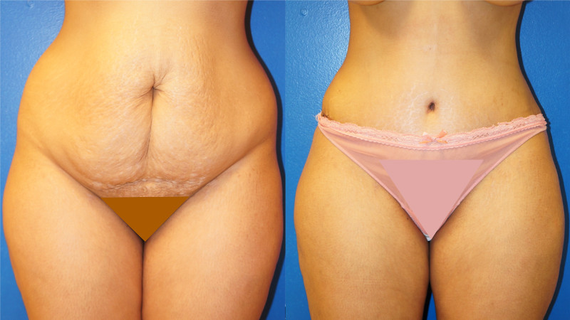 Trim that tummy! 5 important things to know about tummy tuck