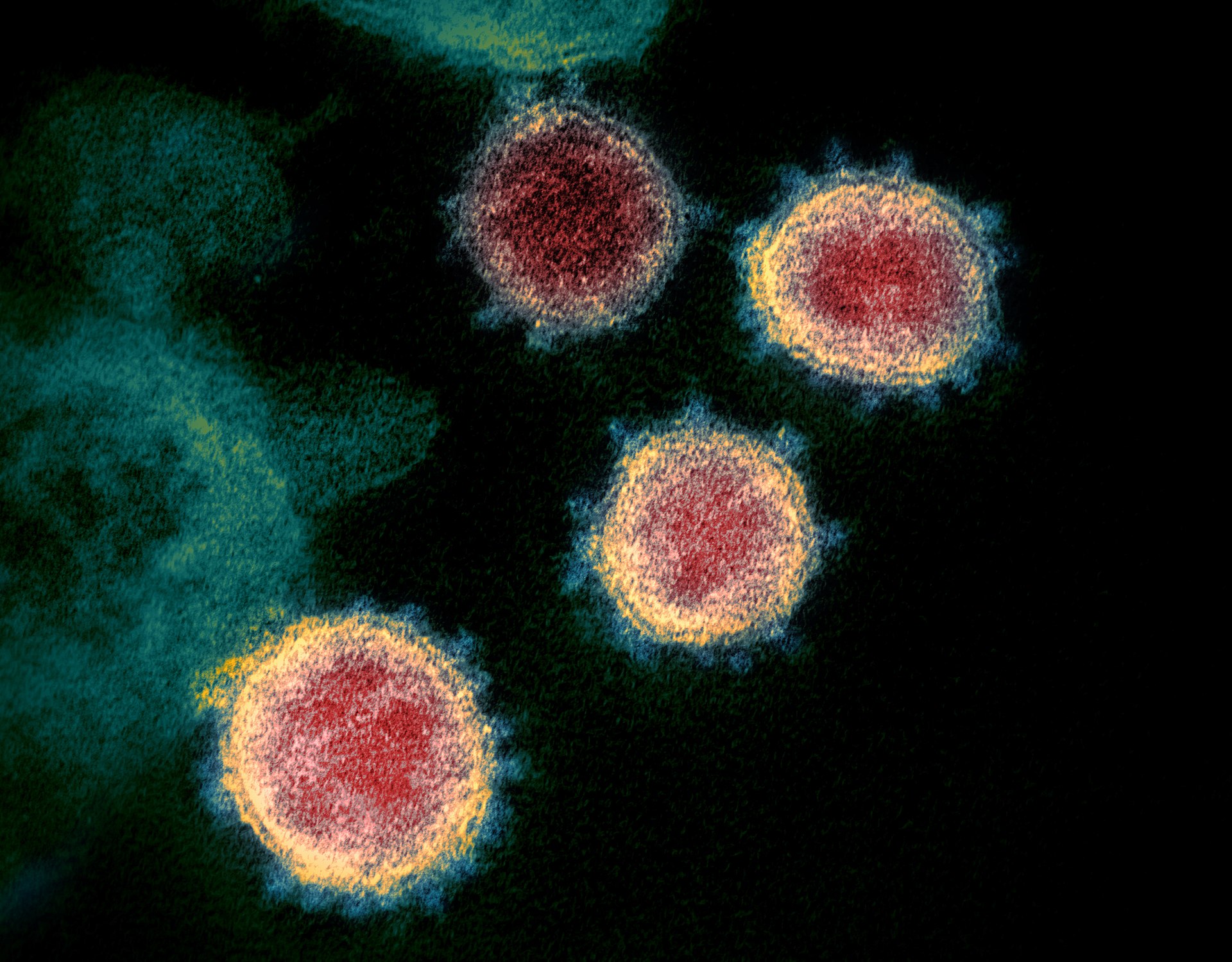 First NY case of COVID-19 Brazilian variant found in NYC resident