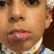 Rochester boy has life-changing surgery in NYC
