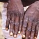 First case of monkeypox registered in Monroe County