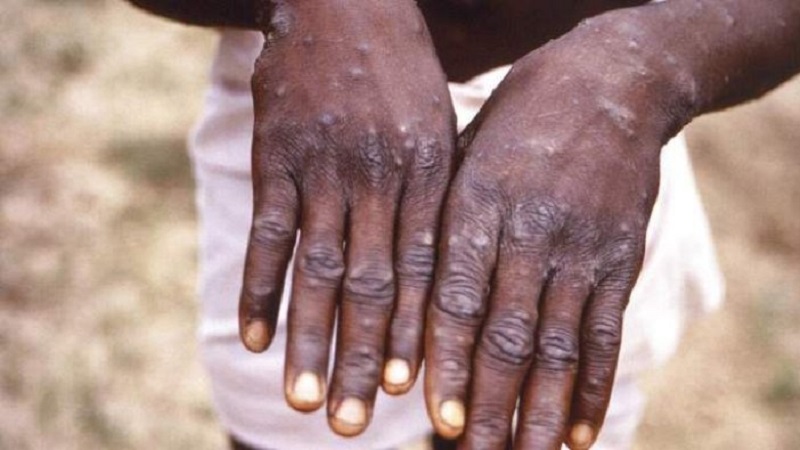 First case of monkeypox registered in Monroe County